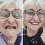 Before and after dental crown installation at AllDental – smile restoration results