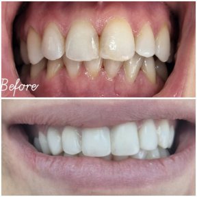 Before and after dental bonding results at AllDental – improved tooth shape and smile