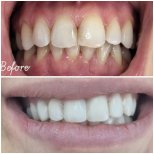 Before and after dental bonding results at AllDental – improved tooth shape and smile
