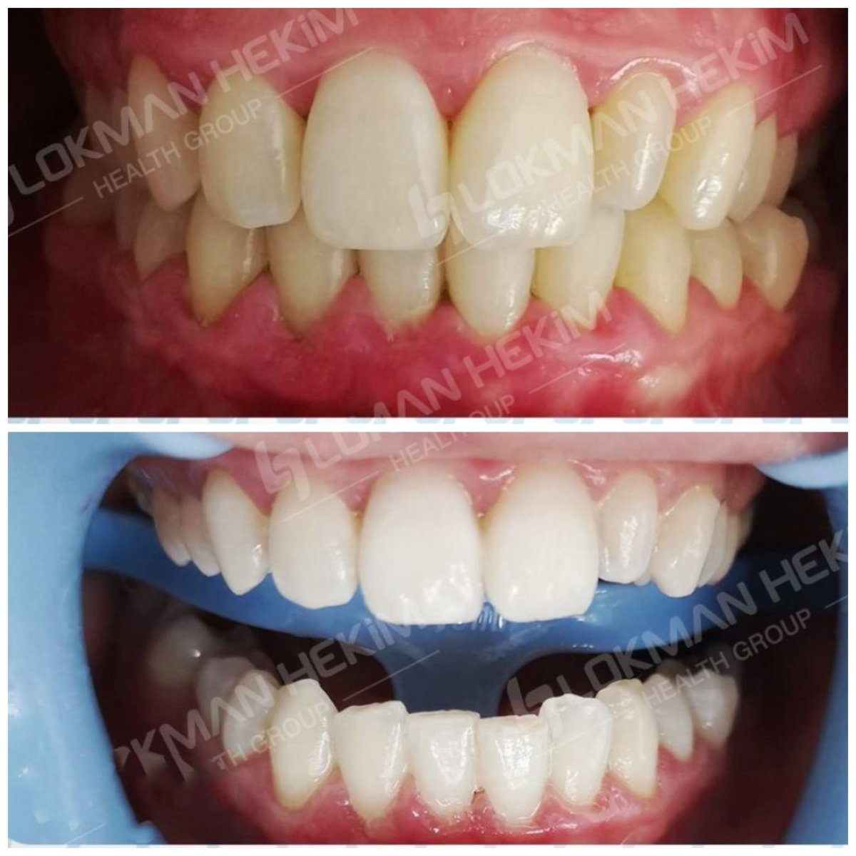 Antes y después de carillas dentales en Lokman Hekim Istanbul Hospital – mejora estética de la sonrisa