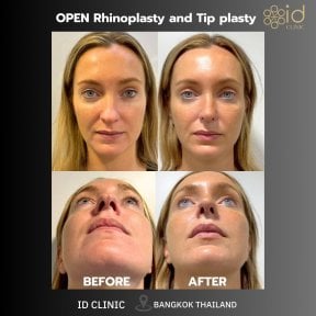 Before and after open rhinoplasty and tip plasty results at ID Clinic Bangkok, nose reshaping