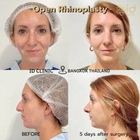 Before and after open rhinoplasty results at ID Clinic Bangkok, nose reshaping after 5 days