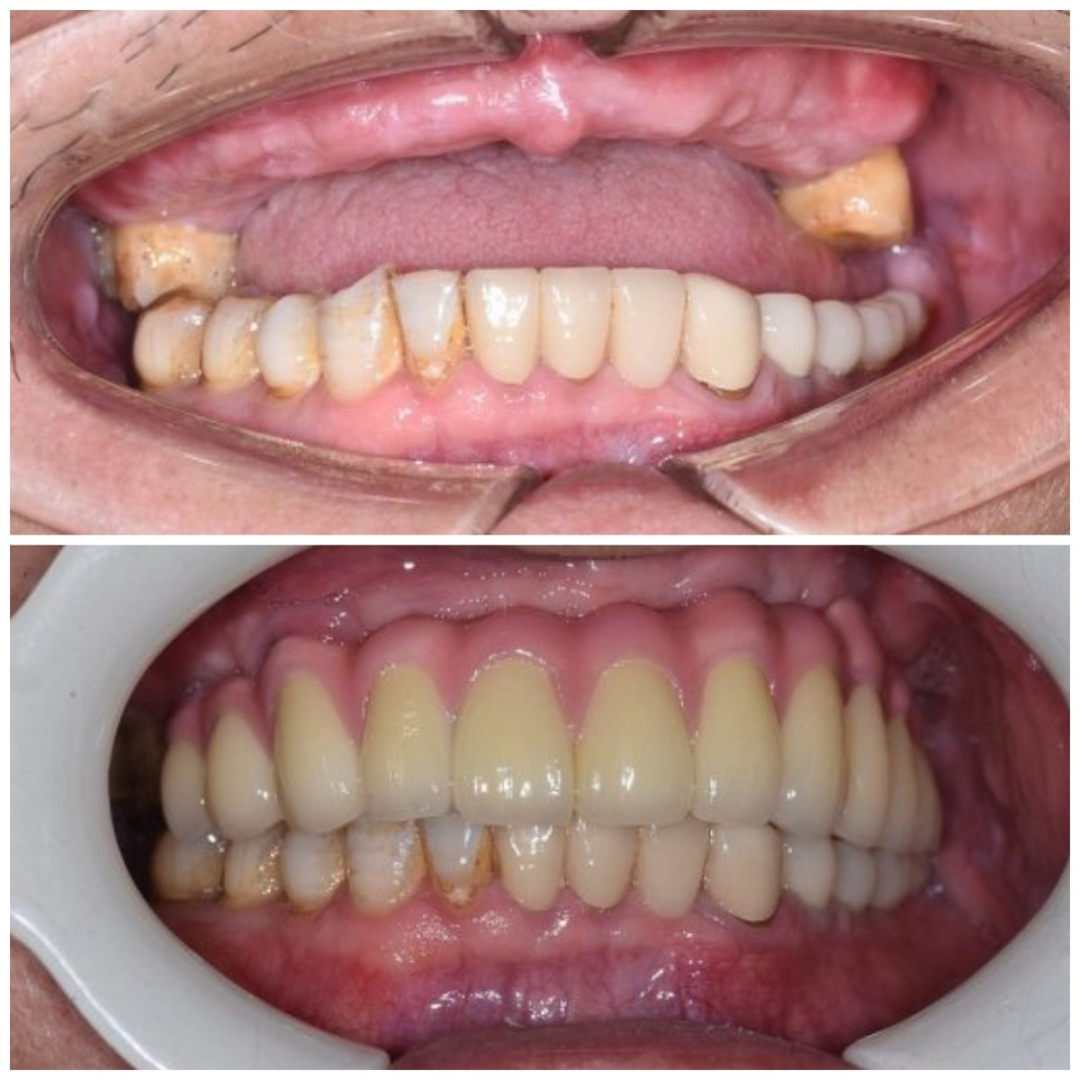 نتائج قبل وبعد زراعة الأسنان في Qinghua Sunshine Dentistry (ووهان)، ابتسامة مستعادة