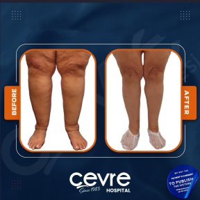 Результаты до и после подтяжки бедер в Adem and Havva Medical Center, улучшенный контур ног
