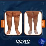 Результаты до и после подтяжки бедер в Adem and Havva Medical Center, улучшенный контур ног