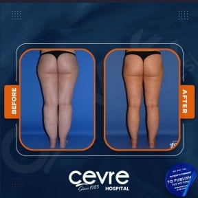 Результаты подтяжки бедер до и после в Adem and Havva Medical Center, стройные бедра