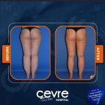 Результаты подтяжки бедер до и после в Adem and Havva Medical Center, стройные бедра