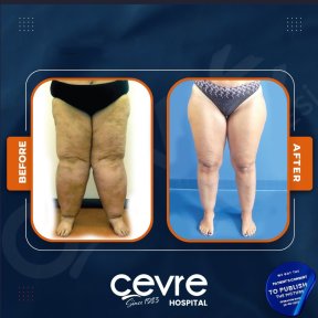Результаты подтяжки бедер до и после в Adem and Havva Medical Center, улучшенный контур ног