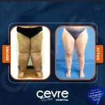 Результаты подтяжки бедер до и после в Adem and Havva Medical Center, улучшенный контур ног