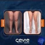 Результаты подтяжки бедер до и после в Adem and Havva Medical Center, стройные ноги