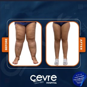 Результаты подтяжки бедер до и после в Adem and Havva Medical Center, улучшенный контур ног