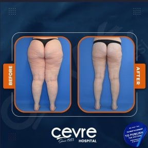 Результаты подтяжки бедер до и после в Adem and Havva Medical Center, улучшенный контур ног