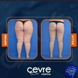 Результаты подтяжки бедер до и после в Adem and Havva Medical Center, улучшенный контур ног