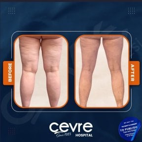 Результаты подтяжки бедер до и после в Adem and Havva Medical Center, улучшенный контур ног