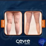 Результаты подтяжки бедер до и после в Adem and Havva Medical Center, улучшенный контур ног