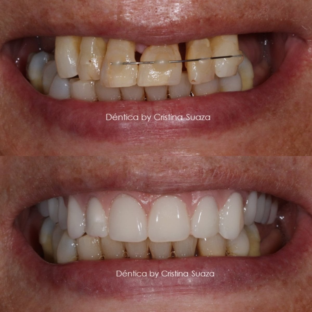 نتيجة قبل وبعد زراعة أسنان زركونيا All-on-4 في عيادة Dentica by Cristina Suaza