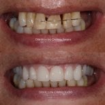 Результат до и после установки циркониевых All-on-4 имплантов в Dentica by Cristina Suaza