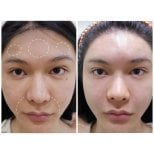 Before and after fillers injection at Somchai Clinic, facial contouring and volume restoration result