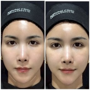 Before and after fillers injection at Somchai Clinic, visible jawline contouring result