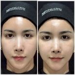 Before and after fillers injection at Somchai Clinic, visible jawline contouring result