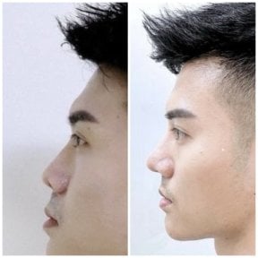 Before and after rhinoplasty result at Somchai Clinic, improved nose shape and profile