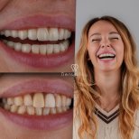 Результаты отбеливания зубов до и после в Dentaray Clinic, заметно более яркая улыбка