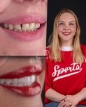 Результаты до и после отбеливания зубов в клинике Dentaray, сияющая улыбка