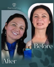 Результаты отбеливания зубов до и после в клинике Dentaray, заметно более яркая улыбка