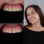 Результаты отбеливания зубов до и после в Dentaray Clinic, заметно более яркая улыбка