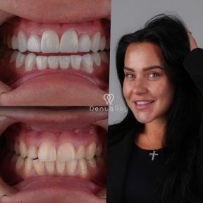 До и после установки виниров в клинике Dentaray – результаты преображения улыбки