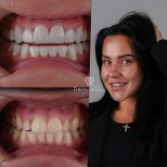 До и после установки виниров в клинике Dentaray – результаты преображения улыбки