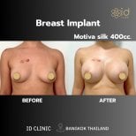 Before and after breast augmentation with Motiva 400cc at ID Clinic Bangkok, visible results