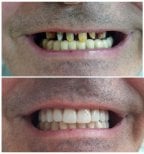 Before and after zirconia crown installation at AllDental – smile restoration results