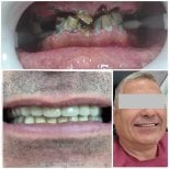 Before and after zirconia crown installation at AllDental – smile restoration results