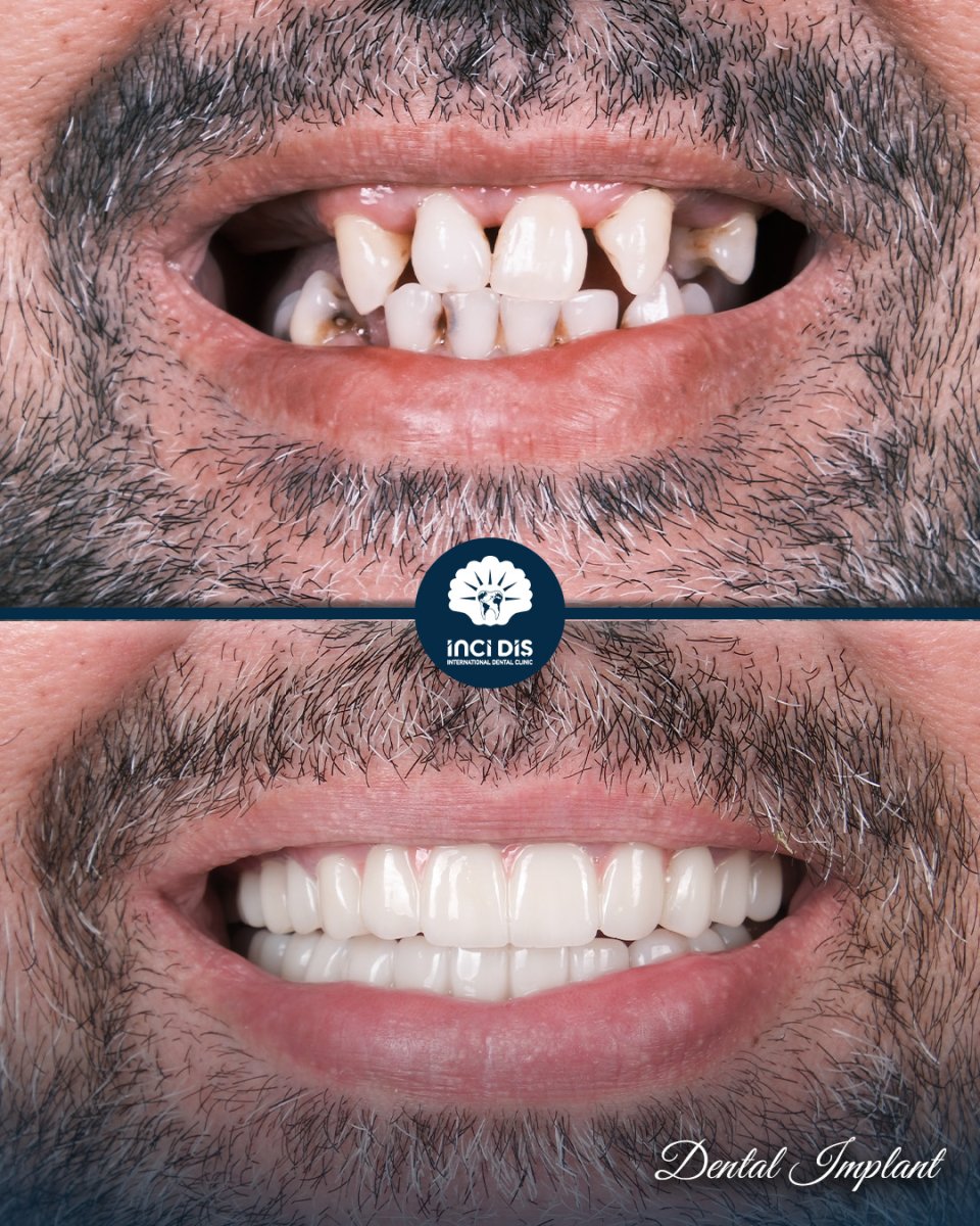 Resultados antes y después de implantes dentales en Inci Dis International Dental Clinic, restauración de sonrisa