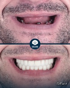 before-after photo dental-implant