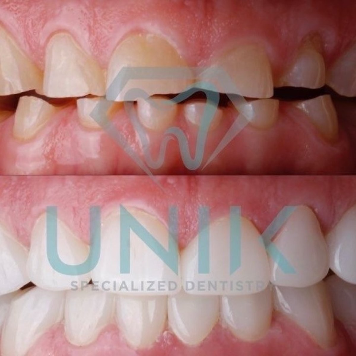 نتائج قبل وبعد تركيب تيجان الزركونيا في عيادة Unik Specialized Dentistry، استعادة الابتسامة