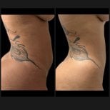 Before and after liposuction results at Dr. Felipe Mazzillo Plastic Surgery Clinic, waist contour