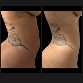 Before and after liposculpture results at Dr. Felipe Mazzillo Plastic Surgery Clinic, waist contour