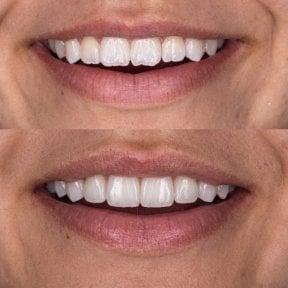 До та після smile makeover у Dental Bliss, помітний результат відбілювання та вирівнювання зубів