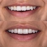 До та після smile makeover у Dental Bliss, помітний результат відбілювання та вирівнювання зубів