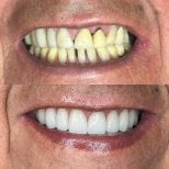 Результати до і після Smile makeover у Dental Bliss – покращення кольору та рівності зубів
