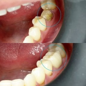 До та після встановлення зубної коронки в Dental Bliss, відновлений корінний зуб