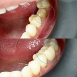 До та після встановлення зубної коронки в Dental Bliss, відновлений корінний зуб