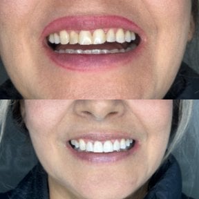 До та після smile makeover у Dental Bliss, помітний результат відбілювання та вирівнювання зубів