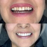 До та після smile makeover у Dental Bliss, помітний результат відбілювання та вирівнювання зубів