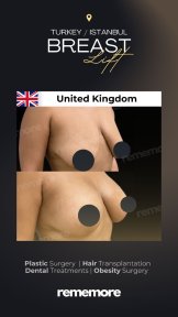 before-after photo mammoplasty