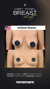 before-after photo mammoplasty