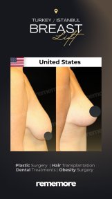 before-after photo mammoplasty