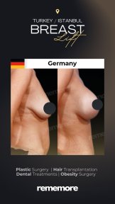 before-after photo mammoplasty